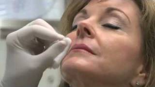 Radiesse in Nasolabial Folds  deNovo Medical Group  Dallas [upl. by Yaya659]