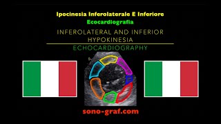 Ecocardiografia  Ipocinesia Inferolaterale E Inferiore [upl. by Schaeffer300]