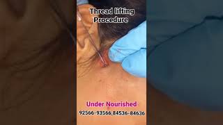 Thread lifting Procedure  Under Nourished Women [upl. by Wiener]