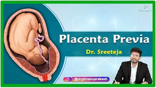 Placenta Previa Etiology Pathophysiology Clinical presentation Diagnosis and Treatment [upl. by Josiah]