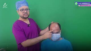 Grade 6 Baldness Fue Hair Transplant Marking amp Planning  Dr Jayanta Bain Kolkata [upl. by Eibbor]