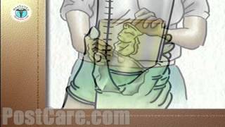 Discharge Emptying a Urinary Drainage Bag MiniFree Patient Education Medical Video [upl. by Gascony]