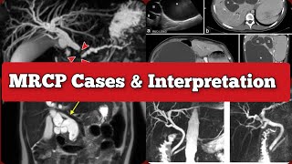 Radiology Viva Cases  137138  MRCP Primary Sclerosing Cholangitis medical radiology doppler [upl. by Thanos]