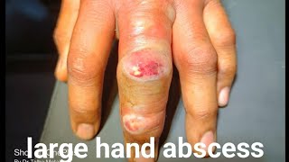 large hand and finger abscessneglected abscesshath me pusincision and drainagelocal anesthesia [upl. by Archangel]