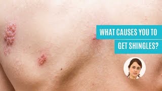 What Causes You To Get Shingles Herpes Zoster – Symptoms amp Treatment [upl. by Moll]