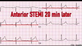 hyper acute t waves STEMI [upl. by Trutko127]