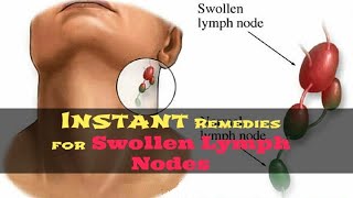 How to Get Rid of Swollen Lymph Nodes Naturally  5 Remedies for Swollen Lymph Nodes in Neck [upl. by Fabe591]