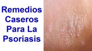 Qué es y como curar la Psoriasis con Remedios Naturales [upl. by Ojela75]