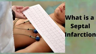 What is a Septal Infarction [upl. by Nata]