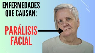 7 enfermedades que causan parálisis facial [upl. by Weissmann876]