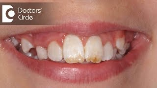 How do you treat Dental Fluorosis  Dr Aniruddha KB [upl. by Vigen614]