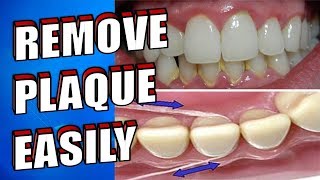 NATURALLY REMOVE DENTAL PLAQUE EASILY IN 5 MINUTES AT HOME WITHOUT VISITING THE DENTIST [upl. by Anaicul]