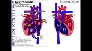 55 Dextrocardia PAPVR azygos continuation [upl. by Lilybelle867]