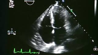 Atrial Fibrillation On Echocardiogram [upl. by Ymmit160]