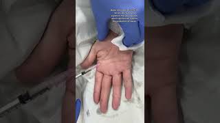 Hyperhidrosis Treatment in skinaa clinic [upl. by Klump844]