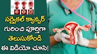 What is Cervical Cancer   Cervical Cancer Causes Diagnosis and Symptoms  Y5 Tv [upl. by Ahsratan]