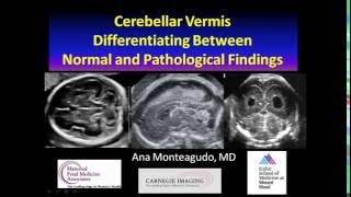 AIUM Webinar Cerebellar Vermis [upl. by Immak]