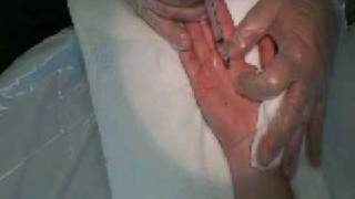 Palmar Hyperhidrosis Botox Procedure [upl. by Nnaeilsel989]