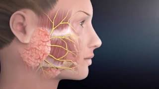 Parotid Surgery Animation  Overview of Minimally Invasive Parotidectomy [upl. by Fields64]