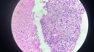 Bilateral TB Pleurisy with Adenitis  The Tale of two most common Extra Pulmonary TB [upl. by Atteynad376]