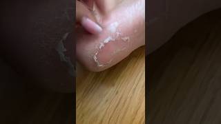 Crazy and Satisfying Peeling after using the Plantifique Foot Peel Mask ✨ Baby Soft Feet in 7 Days [upl. by Gussman]