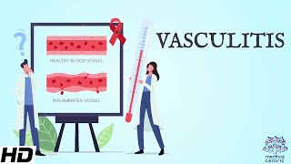 Vasculitis Everything You Need To Know [upl. by Trask]