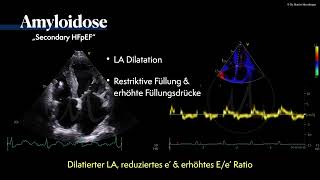 〖Echokardiografie〗 Amyloidose  HFpEF Phänotyp🫀 [upl. by Averil]