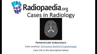 Periventricular leukomalacia Radiopaediaorg Cases in Radiology [upl. by Killen]