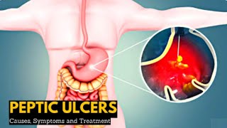 Peptic Ulcer Disease  पेप्टिक अल्सर रोग  Types  Causes  Pathophysiology  Hindi  Urdu [upl. by Webster]