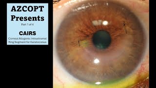 Treatment of Keratoconus CAIRS Corneal Allogenic Intrastromal Ring Segment Case 1 [upl. by Humbert713]