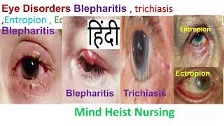 Eye DisordersBlepharitis  trichiasis Entropion  Ectropion Medical Surgical II 3rd Bsc Nursing [upl. by Enywad]