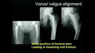 Biomechanics of the Hip Joint [upl. by Ntsud]