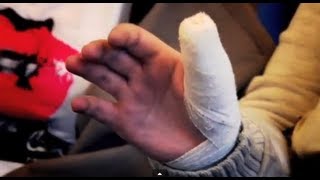 Thumb Mishap  Bizarre ER [upl. by Rutter]