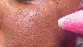 DPN Dermatosis Papulosa Nigra Removal [upl. by Annora918]