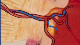 What is Central Retinal Vein Occlusion CRVO [upl. by Ahsenrat869]