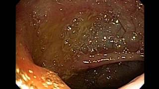 COLONOSCOPIA COLITIS ULCEROSA CUCI NGELMED [upl. by Meit]