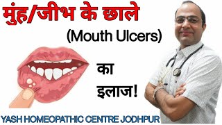 मुँह के छाले का ईलाज । Mouth tongue lips ulcer homeopathic treatment ।best treatment।home remedy [upl. by Orin]