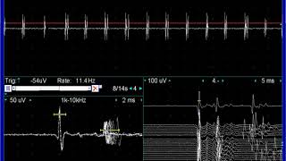 Myokymic discharges doublets triplets in facial nerve lesion [upl. by Rheims482]