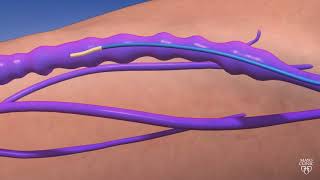 Guiding Light An Animated Journey through Endovenous Thermal Ablation [upl. by Reisman]