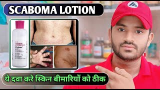 Scaboma lotion uses dose benefits and Side effects full review in hindi [upl. by Leahsim531]