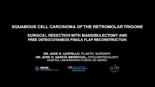 Squamous cell carcinoma of the retromolar trigone Resection and free fibula flap reconstruction [upl. by Cammi]