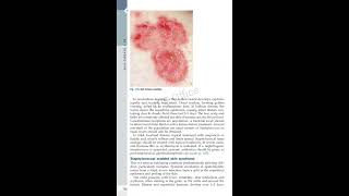 Dermatology  davidsons essentials of medicine [upl. by Kramal]