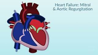 Rheumatic Heart Disease by E Rusingiza  OPENPediatrics [upl. by Rinee]