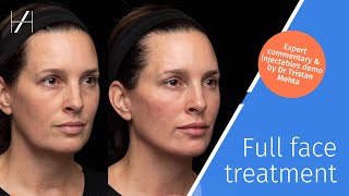 Full Face Dermal Fillers Treatment Demonstration by Dr Tristan Mehta [upl. by Blaire259]