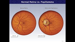 Cause of Papilledema and Clinical presentations of Papilledema [upl. by Cresida]