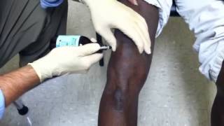 Steroid Knee Injection  Dr George Sutherland Bluffton SC [upl. by Reivaj]