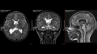 Tumor Ventricular Oligodendroglioma [upl. by Silvie]