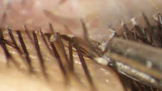 Removing Entire DEMODEX Mites hiding in eyelashes [upl. by Morice153]