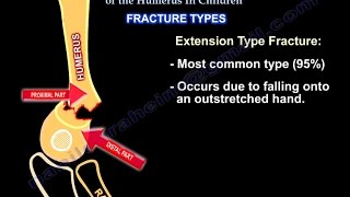 Supracondylar Fractures Of The Humerus In Children [upl. by Winny]