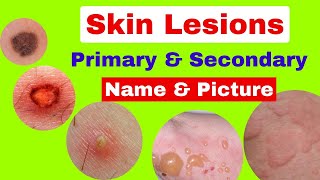 Type of skin lesions with name and picture  Primary and secondary skin lesions  skin diseases [upl. by Gold]